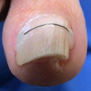 Orthonyxie traitement ongles incarnés Jette Tubize